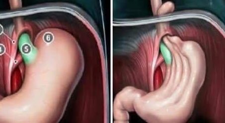 Yemekten Sonra Mide Şişiyorsa Dikkat! Basit Bir Rahatsızlık Değil